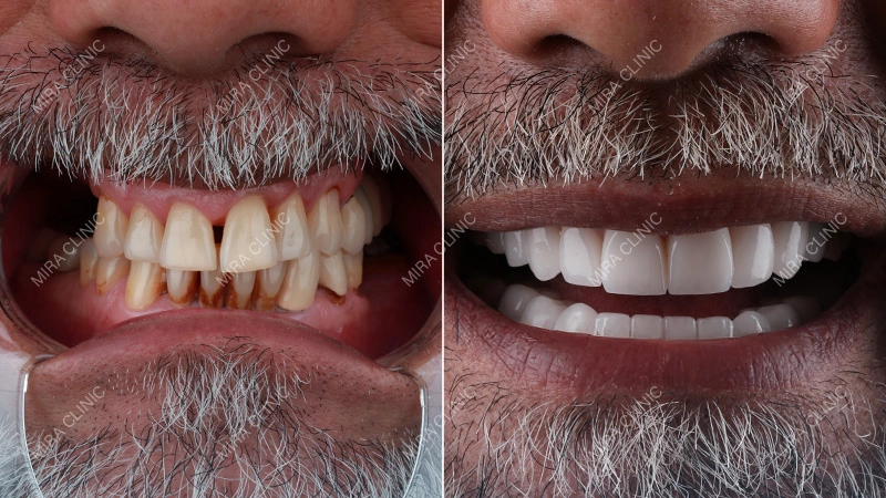 Before and After: Real Zirconia Crown Result
